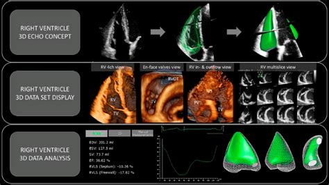 3d volumetric lv volumed|3d rv volume scan.